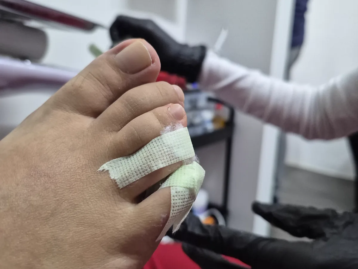 Cuidados posteriores aplicados en un dedo del pie